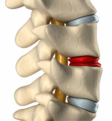 Spinal-stenosis-img1