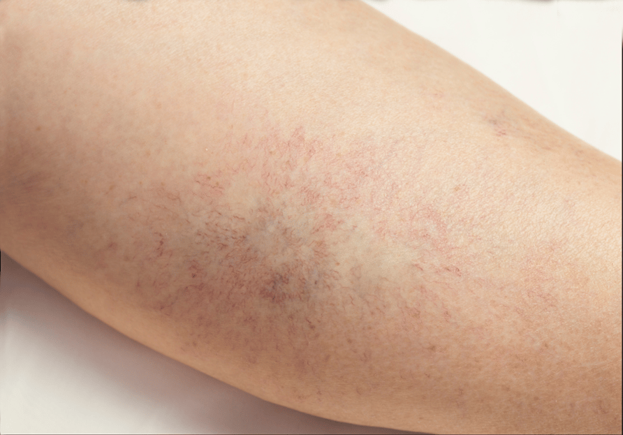 dvt-arm