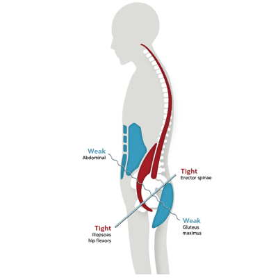 lower-muscle-imbalance