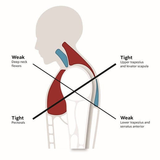 muscle-imbalances